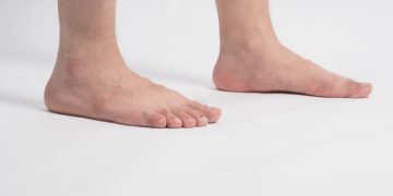 أسباب الفلات فوت